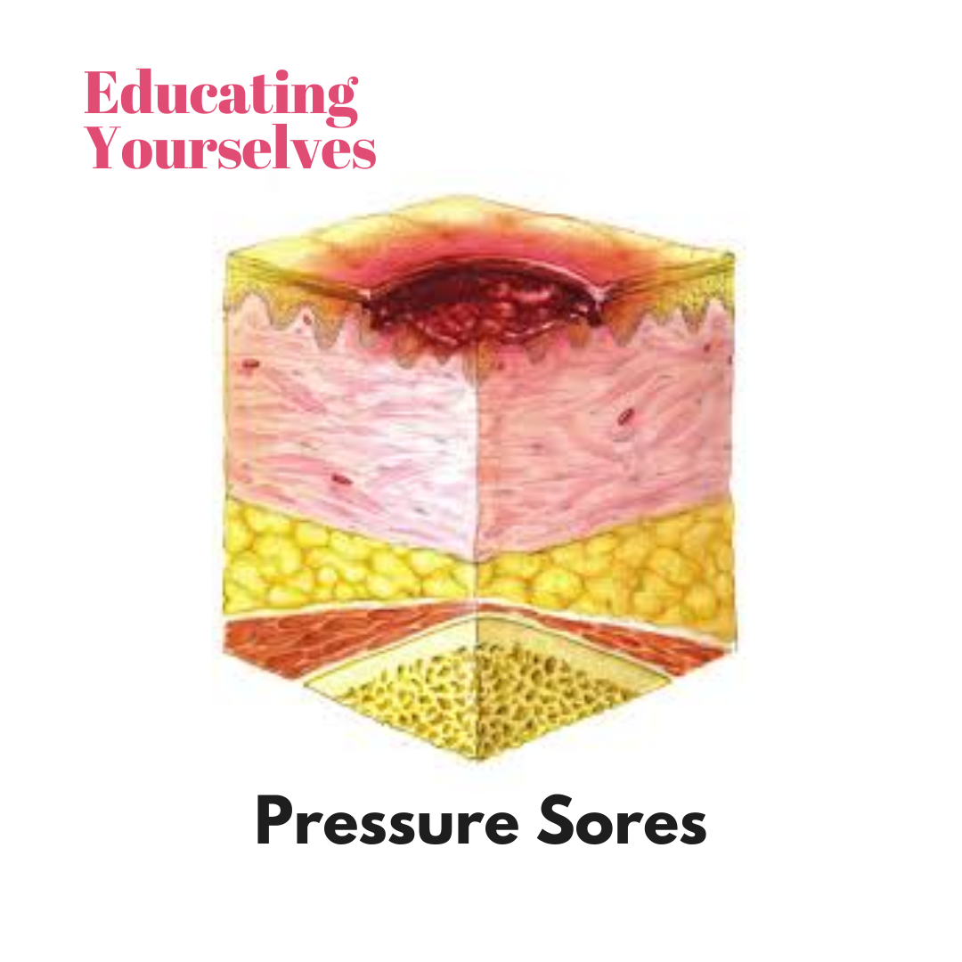 Educating Yourselves: Pressure Sores